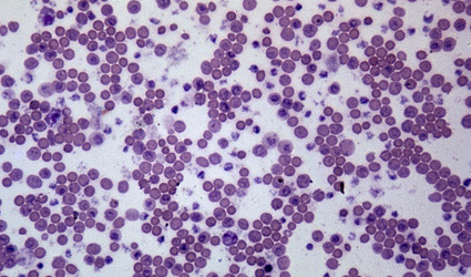 Image: Human blood from a patient suffering from septicemia (photo courtesy Ralph Hutchings, Visuals Unlimited). Image: Human blood from a patient suffering from septicemia (photo courtesy Ralph Hutchings, Visuals Unlimited).
